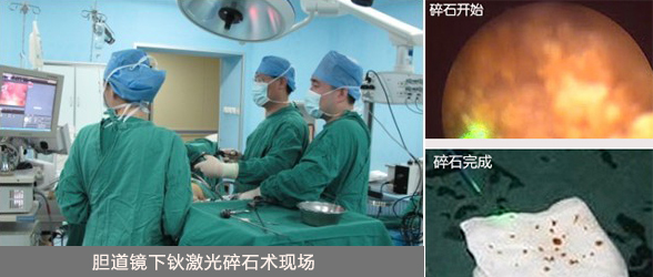 胆道镜下钬激光碎石术.jpg