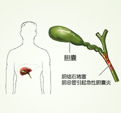 胆囊炎